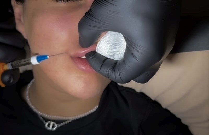 Expert preparation of botox for wrinkle reduction