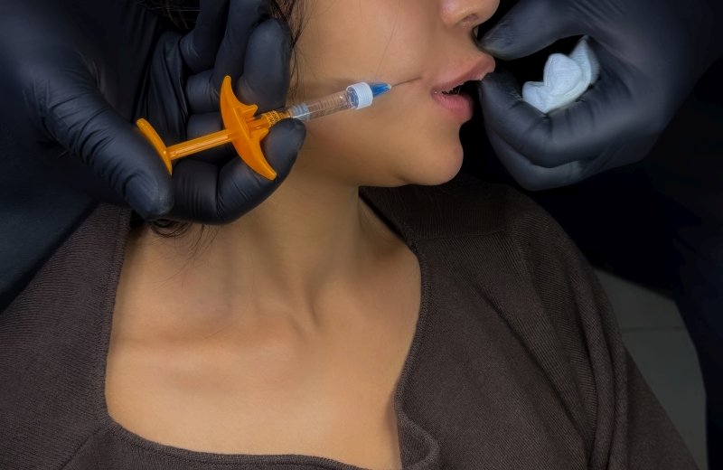 Subtle, natural-looking lip augmentation using premium hyaluronic acid fillers