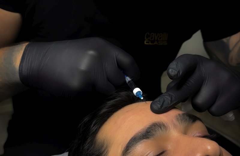 Balanced chin and jawline enhancement with injectables